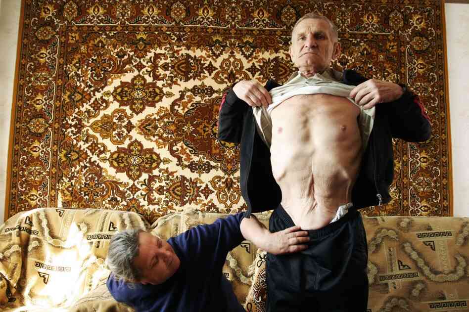 Viktor Gaidak with his wife, Lydia, in their apartment in the outskirts of Kiev, Ukraine, in April 2007. Gaidak worked for 24 years as an engineer at the Chernobyl plant, including nine years after the accident. Here, he shows his scar from a 2004 surgery for colon cancer. 