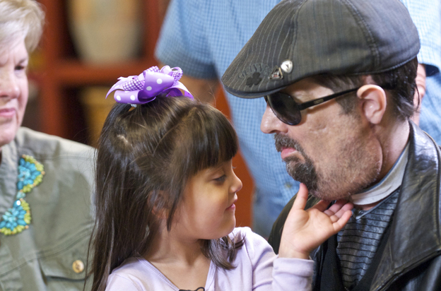 Scarlette Wiens touches the chin of her father, face-transplant recipient Dallas Wiens.