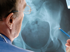 Artificial hips have been a big advancement in treating debilitating arthritis. But there have been reports of medical issues — some serious — in patients with all-metal implants. Artificial hips have been a big advancement in treating debilitating arthritis. But there have been reports of medical issues — some serious — in patients with all-metal implants.