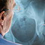 Artificial hips have been a big advancement in treating debilitating arthritis. But there have been reports of medical issues — some serious — in patients with all-metal implants. Artificial hips have been a big advancement in treating debilitating arthritis. But there have been reports of medical issues — some serious — in patients with all-metal implants.