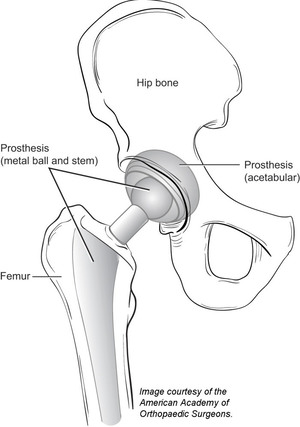 A diagram of a total hip replacement. A diagram of a total hip replacement.