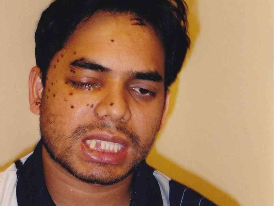 Rais Bhuiyan after he was shot in the face on Sept. 21, 2001.