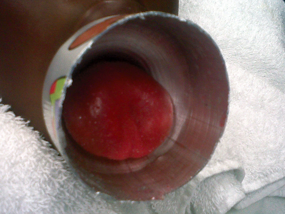 A 9-year-old boy's tongue just before it was freed from the neck of a metal water bottle by Duke University doctors.