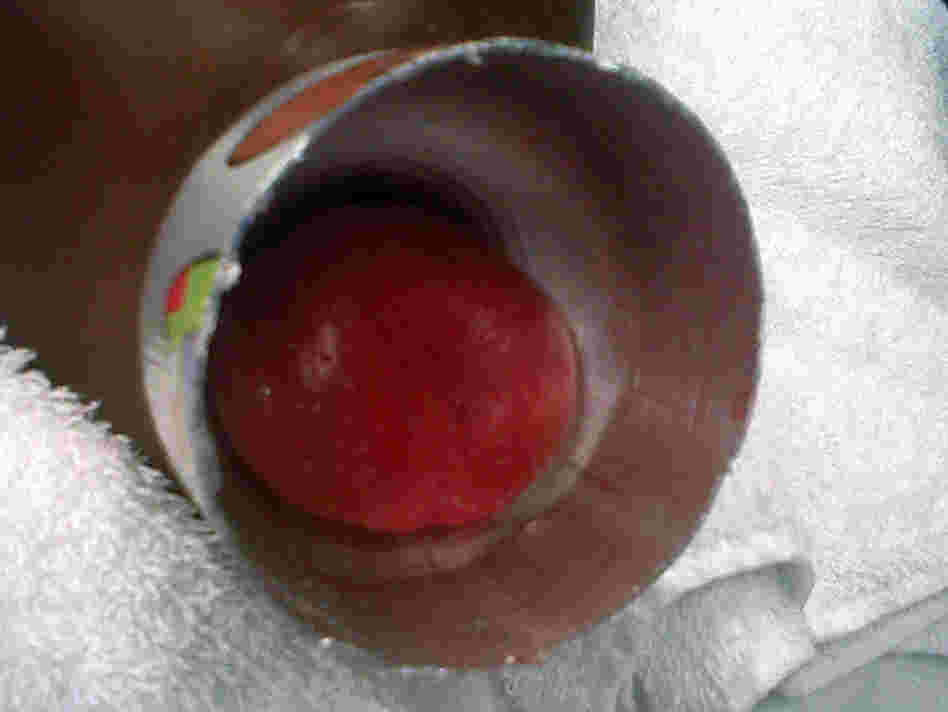 A 9-year-old boy's tongue just before it was freed from the neck of a metal water bottle by Duke University doctors.