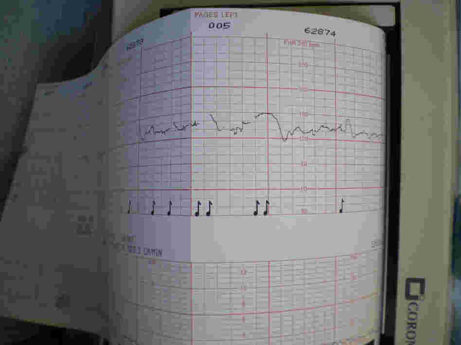 The squiggly lines show Lateefah's baby's heart rate and the  musical notes indicate where she pressed a clicker in response to feeling the baby move.