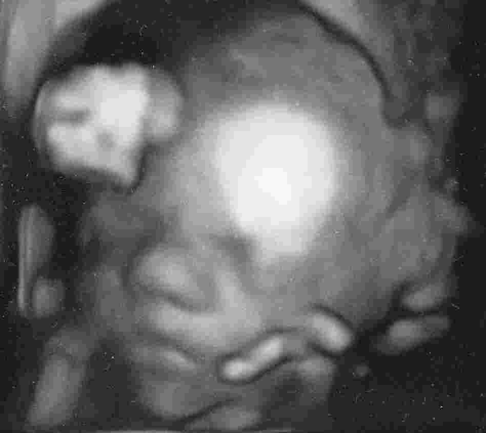A detailed ultrasound of Christy's daughter — shown with light hitting her forehead — has eased some of Christy's concerns over the delivery.