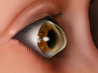 Keratoconus is an eye condition in which the normally round cornea thins, causing a cone-like bulge to develop. Keratoconus is an eye condition in which the normally round cornea thins, causing a cone-like bulge to develop.