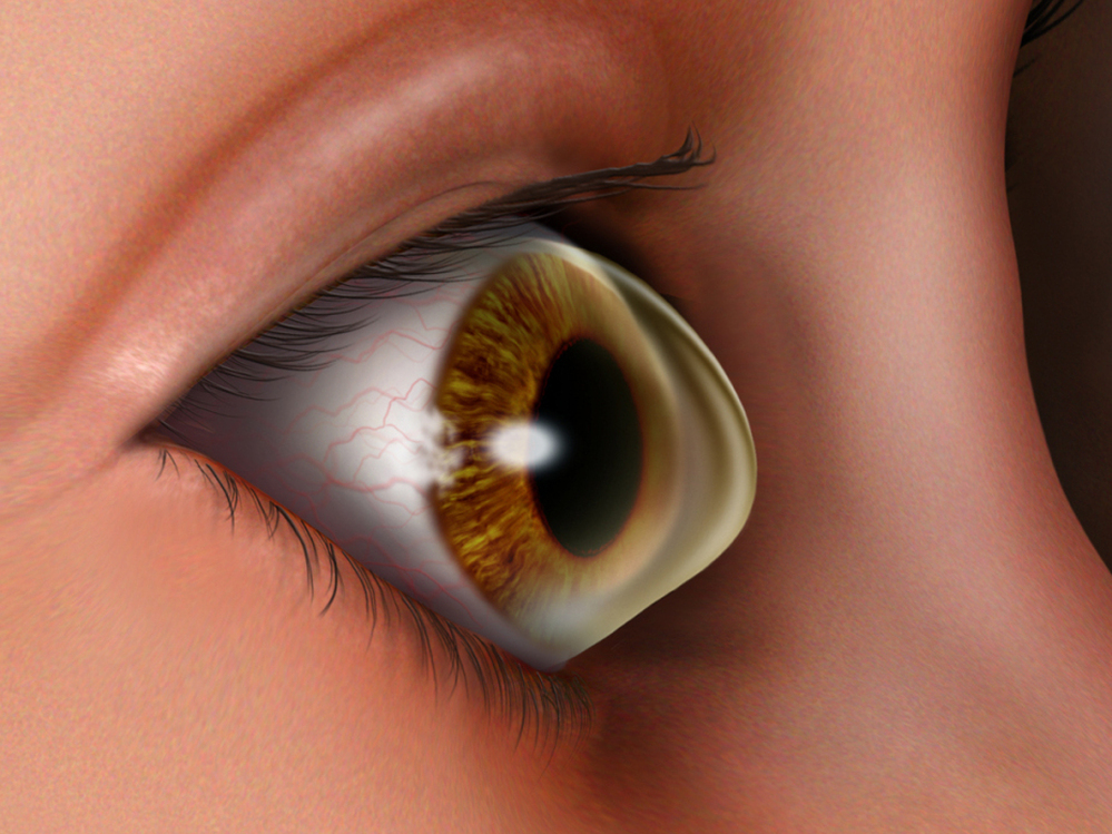 Keratoconus is an  eye condition in which the normally round cornea thins, causing a cone-like bulge to develop.