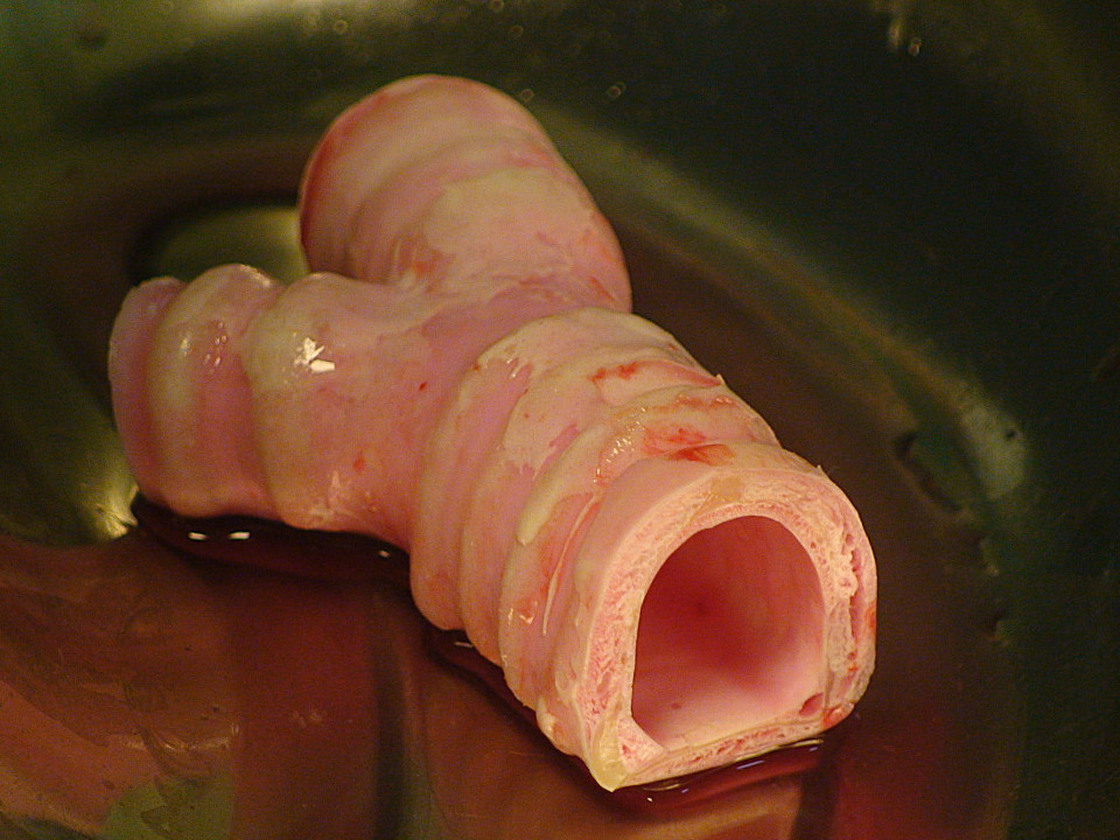 In a first, this artificial windpipe was implanted in an Eritrean man stricken with cancer.
