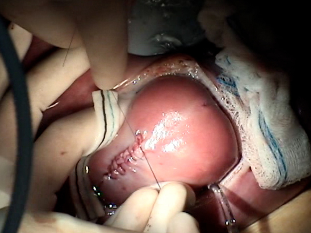 The fetus's back "looks a little  bit like the laces of a miniature football" after surgery, says Dr. Scott Adzick, chief of surgery at Children's Hospital of Philadelphia.
