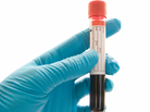A new drug called rivaroxaban may not require as many blood tests for patients with atrial fibrillation as the current drug on the market does. A new drug called rivaroxaban may not require as many blood tests for patients with atrial fibrillation as the current drug on the market does.