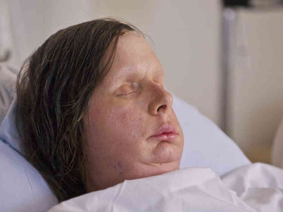 Charla Nash received a full face transplant after she was mauled by a chimpanzee in 2009. The procedure was performed last month by a team of plastic and orthopedic surgeons at Brigham and Women's Hospital in Boston.