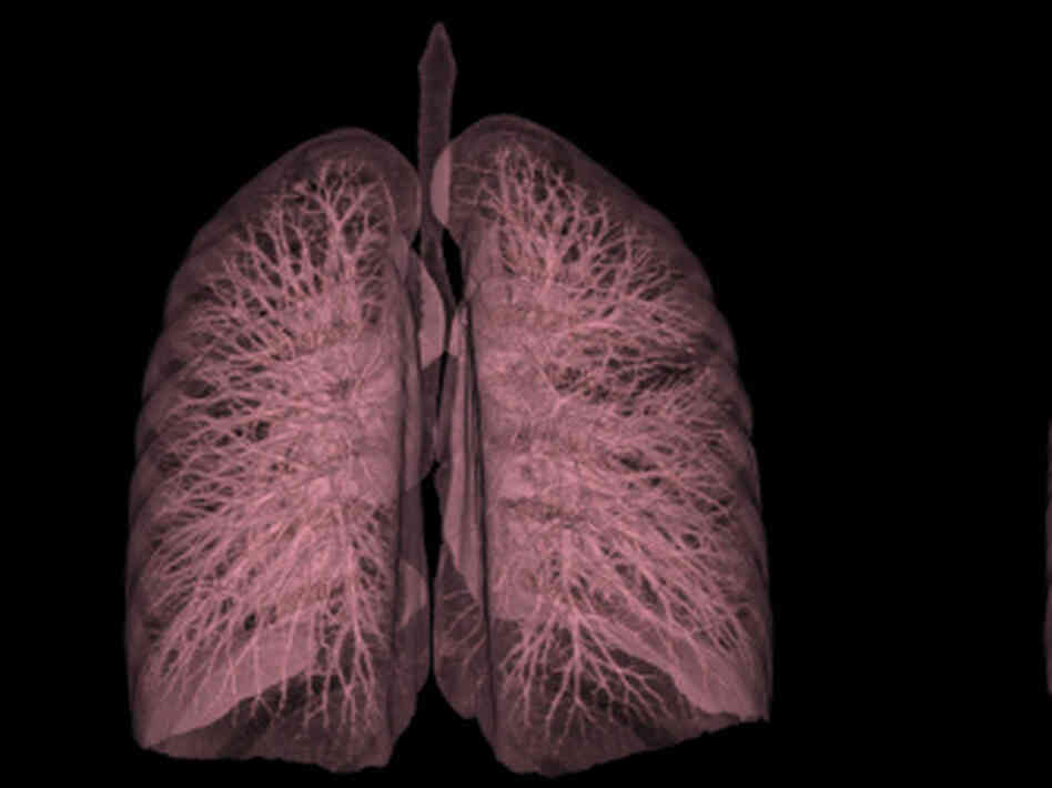 Bargain CT Scans For Smokers More Harm Than Good? Shots Health