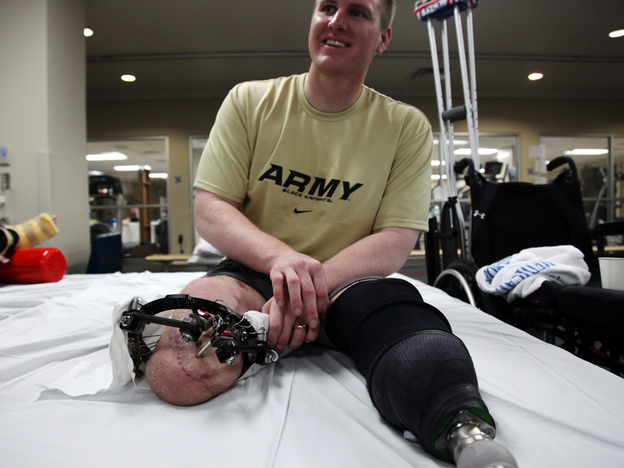 Tyson Quink smiles while examining his knee. "Doesn't it look like a catfish?" he said. Quink is waiting for a bad burn to heal before he can be fitted for his second prosthetic.