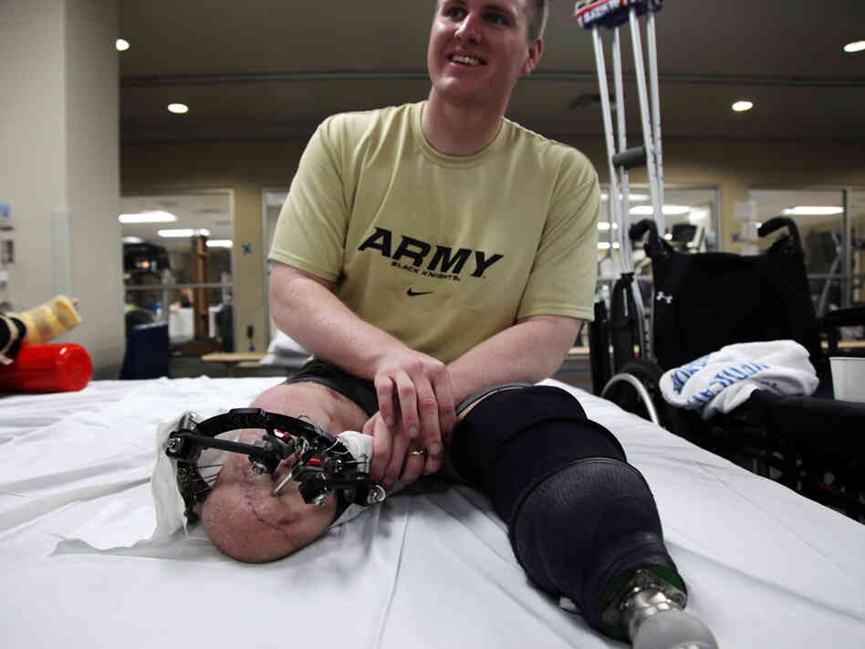 Tyson Quink smiles while examining his knee. "Doesn't it look like a catfish?" he said. Quink is waiting for a bad burn to heal before he can be fitted for his second prosthetic.