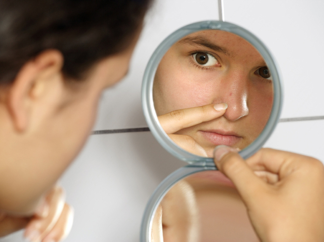 Nearly all teenagers get acne at some point, usually after puberty switches their oil glands into high gear.