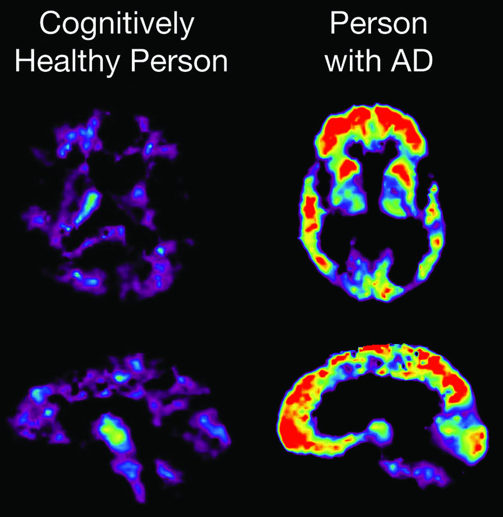 PET scans of the brains of a person with normal memory ability and someone diagnosed with Alzheimer's