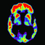 PET scans of the brains of a person with normal memory ability and someone diagnosed with Alzheimer's PET scans of the brains of a person with normal memory ability and someone diagnosed with Alzheimer's