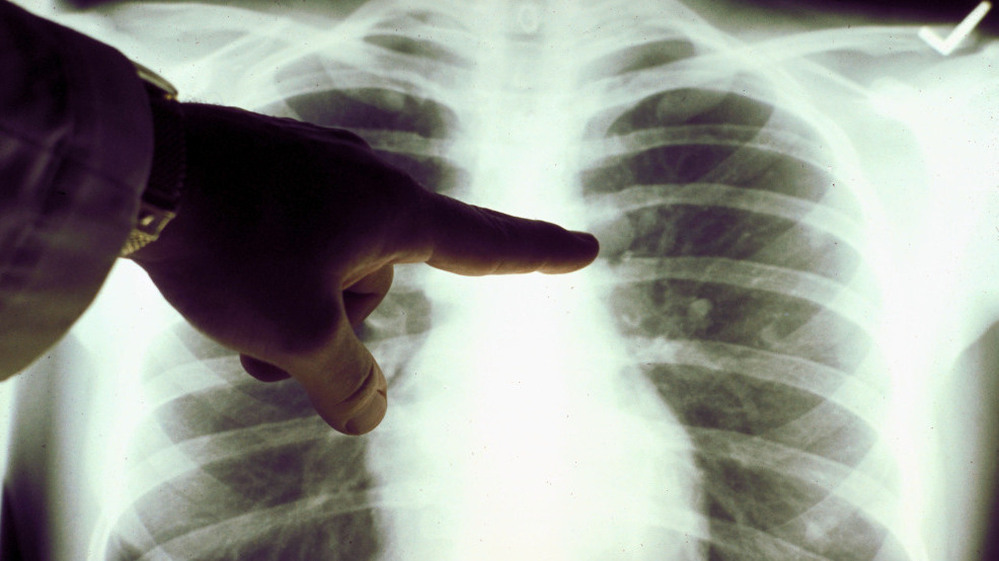 A chest X-ray of a cigarette smoker's lungs.