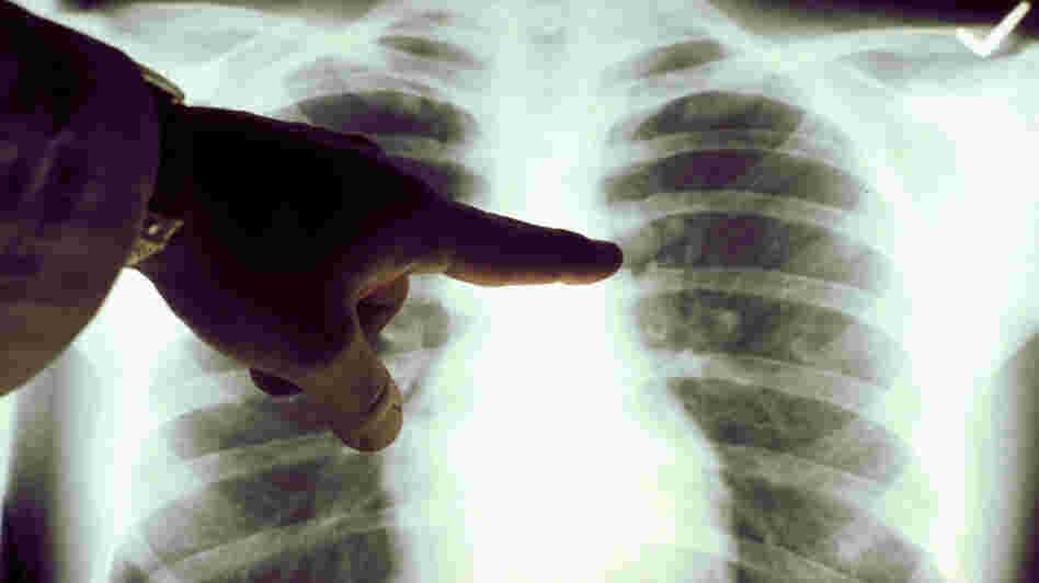 A chest X-ray of a cigarette smoker's lungs.