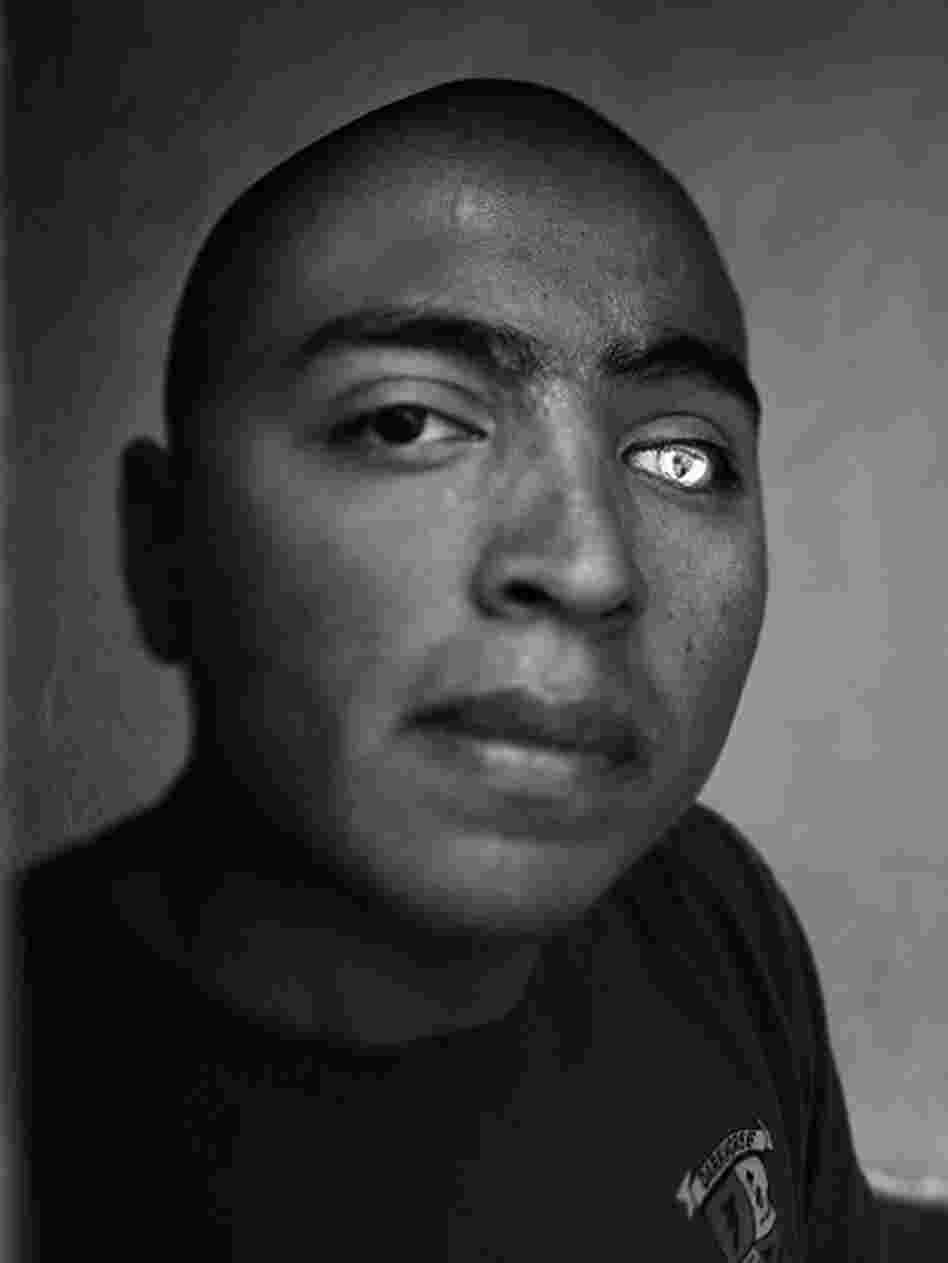 Lance Cpl. Josue Barron lost his left leg and left eye in Sangin, Afghanistan, while serving with the 3/5 Marines from Camp Pendleton, Calif. He now has a glass eye that is emblazoned with the 3/5 insignia.