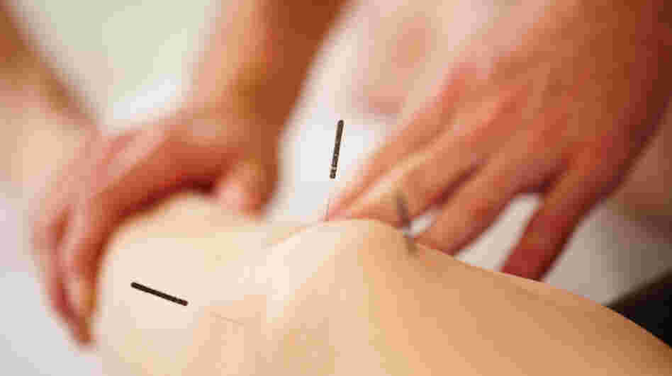 Quite a few hospitals are getting in on the acupuncture act.