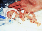 Madeline Mann seen shortly after she was born prematurely in in 1989. Weighing 9.9 ounces at birth, she is now an honors student in psychology at Augustana College in Rock Island, Ill. Madeline Mann seen shortly after she was born prematurely in in 1989. Weighing 9.9 ounces at birth, she is now an honors student in psychology at Augustana College in Rock Island, Ill.
