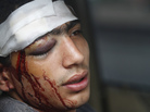 An Egyptian protester rests after being wounded during clashes with soldiers and their supporters in Cairo on Friday. An Egyptian protester rests after being wounded during clashes with soldiers and their supporters in Cairo on Friday.