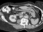 CT scan proves woman was right. She did swallow a pen 25 years ago. CT scan proves woman was right. She did swallow a pen 25 years ago.