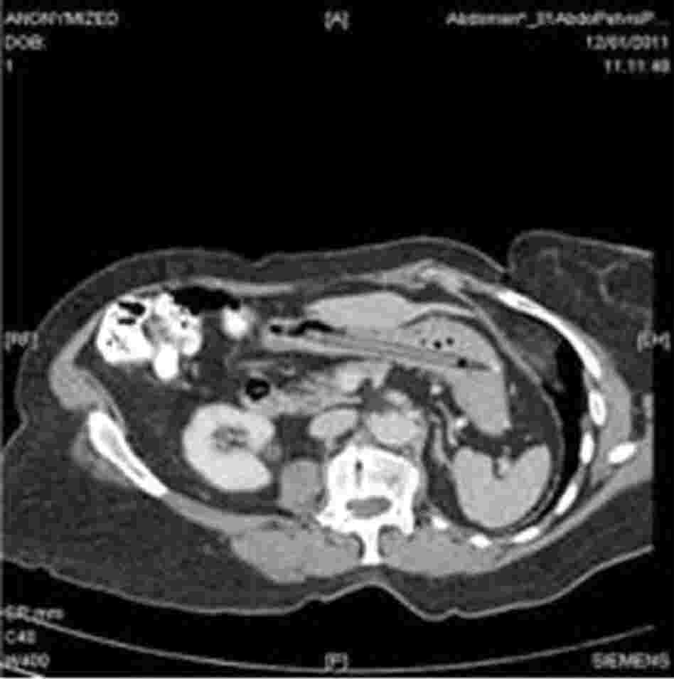 CT scan proves woman was right. She did swallow a pen 25 years ago.
