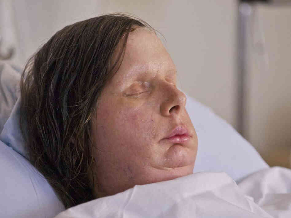 Charla Nash received a full-face transplant after she was mauled by a chimpanzee in 2009.