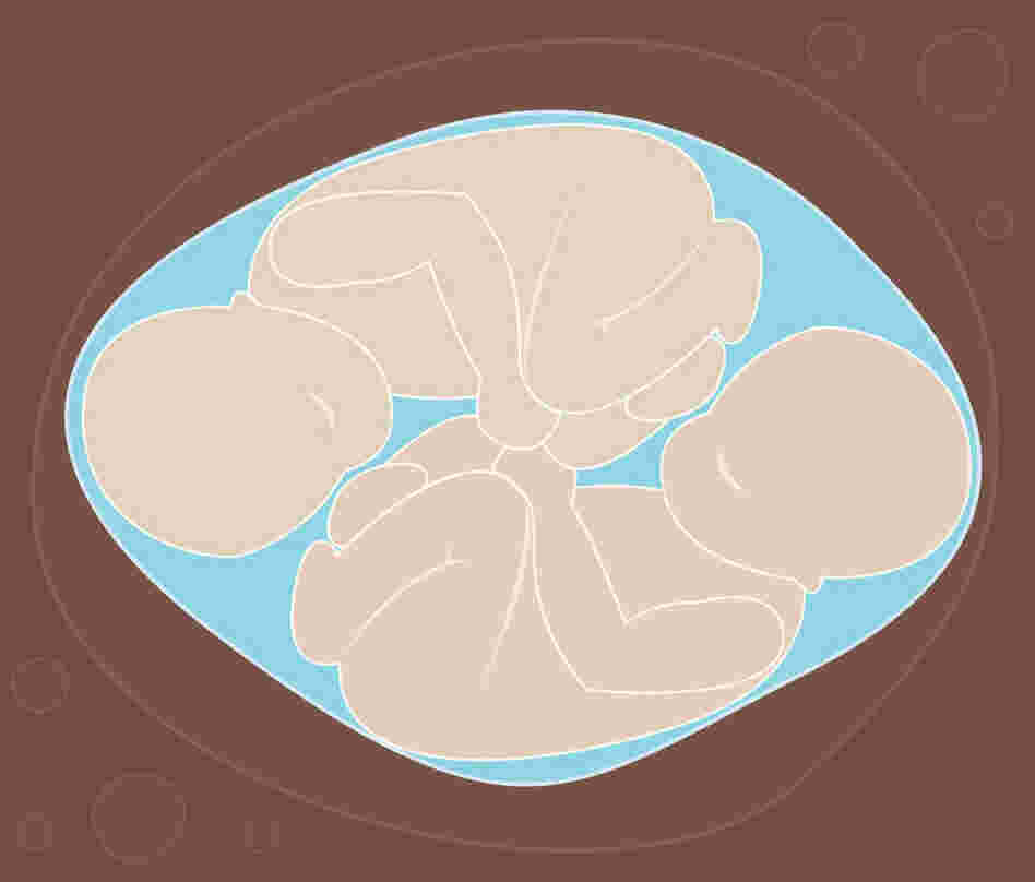 A pair of twins in utero. A pair of twins in utero.
