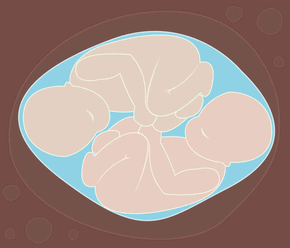 A pair of twins in utero. A pair of twins in utero.