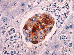A cluster of malignant breast cancer cells that metastasized to the liver. A cluster of malignant breast cancer cells that metastasized to the liver.