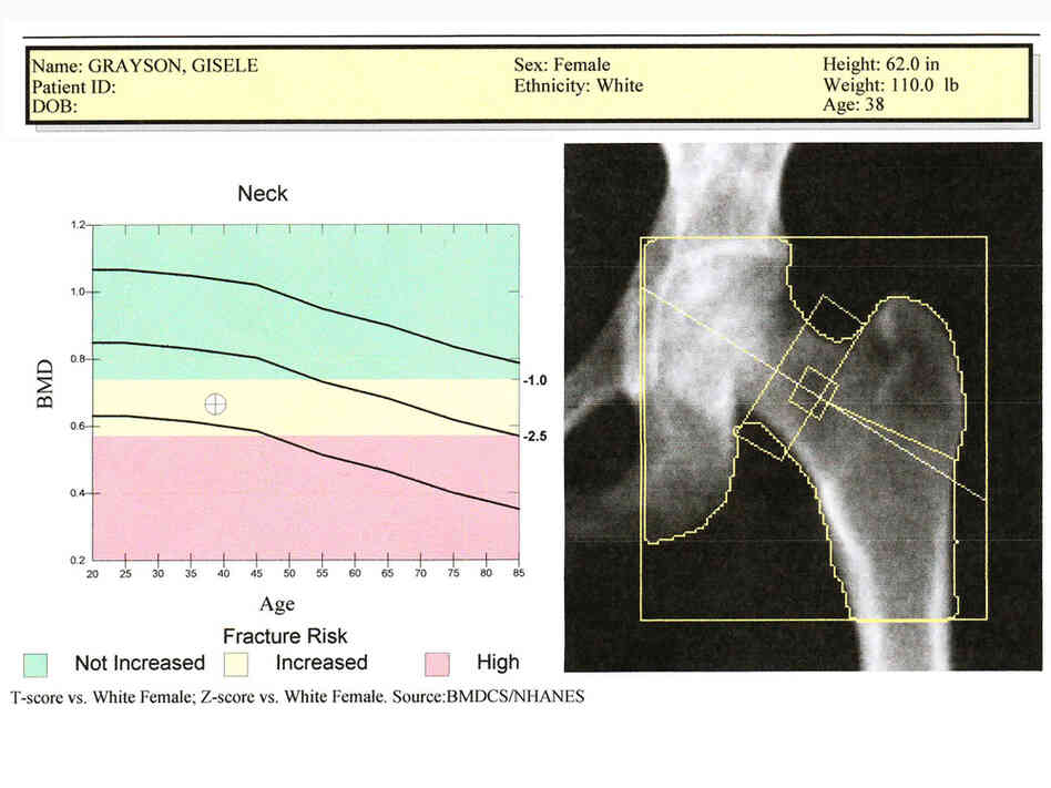 NPR journalist Gisele Grayson got her hip bone scanned a couple of years ago and discovered she has osteopenia.