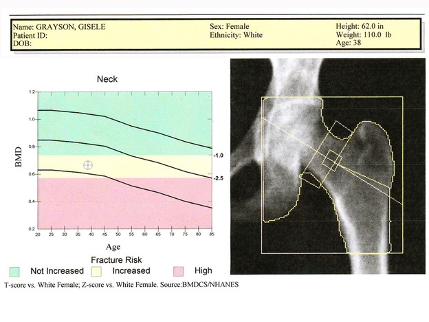 NPR journalist Gisele Grayson got her hip bone scanned a couple of years ago and discovered she has osteopenia.
