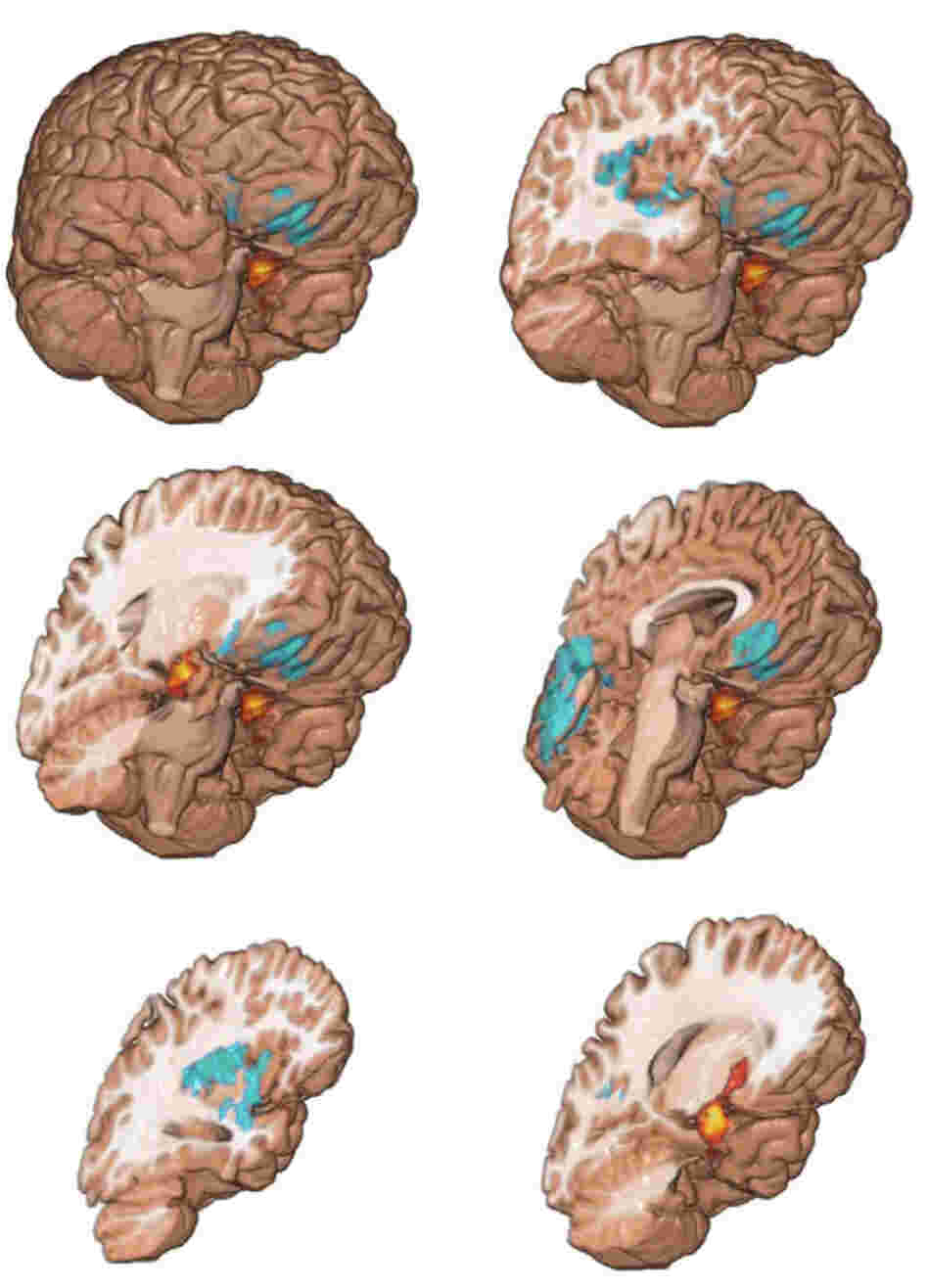 Top 20 Drugs And Their Street Names - Casa.