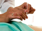 A doctor performs acupuncture on a patient. A doctor performs acupuncture on a patient.