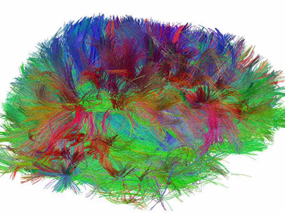 A diffusion spectrum image shows the brain wiring in a healthy human adult. A diffusion spectrum image shows the brain wiring in a healthy human adult.