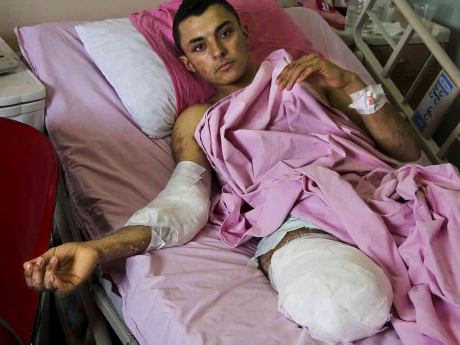 Mohammed Ibrahim lies in a hospital bed in Antakya, Turkey. The 18-year-old Syrian tried to help victims of an artillery shelling in his village near Hama when another shell shattered his right leg. His leg was amputated and his body is filled with shrapnel. 