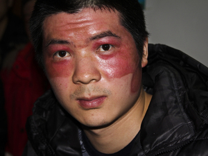 Worker He Wenwen's face was disfigured by a fireball during the December explosion at a plant that produced aluminum backings for Apple's iPad 2. Worker He Wenwen's face was disfigured by a fireball during the December explosion at a plant that produced aluminum backings for Apple's iPad 2.