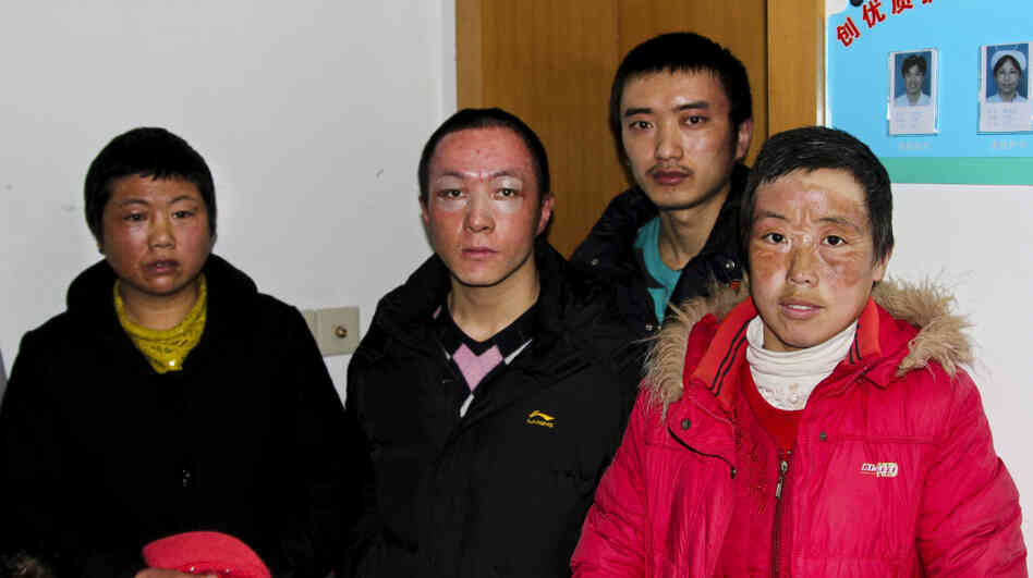 Workers burned during an explosion at an Apple supplier factory in Shanghai are seen at a hospital where they are receiving continued treatment for their injuries. According to the factory, 24 workers were burned in the explosion.