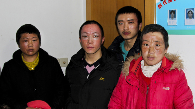 Workers burned during an explosion at an Apple supplier factory in Shanghai are seen at a hospital where they are receiving continued treatment for their injuries. According to the factory, 24 workers were burned in the explosion. Workers burned during an explosion at an Apple supplier factory in Shanghai are seen at a hospital where they are receiving continued treatment for their injuries. According to the factory, 24 workers were burned in the explosion.