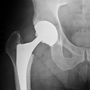 Hip replacements are a boon for aging boomers, but they're not perfect. Hip replacements are a boon for aging boomers, but they're not perfect.