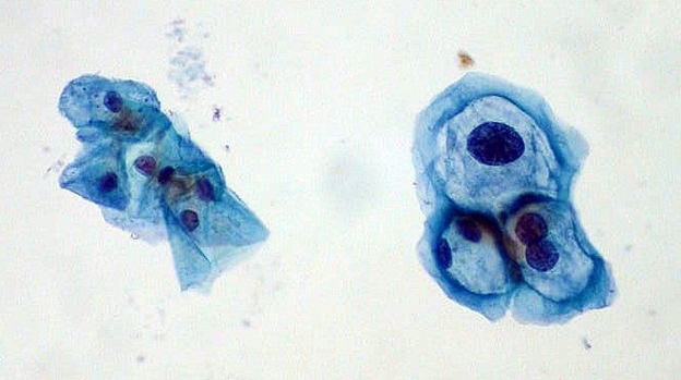Cells gathered during a Pap test. Those on the left are normal, and those on the right are infected with human papillomavirus.