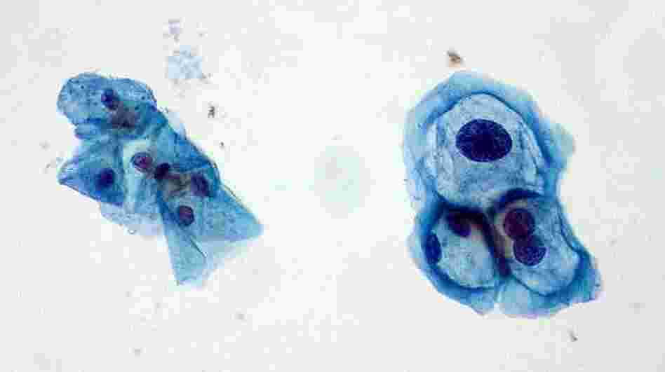 Cells gathered during a Pap test. Those on the left are normal, and those on the right are infected with human papillomavirus.