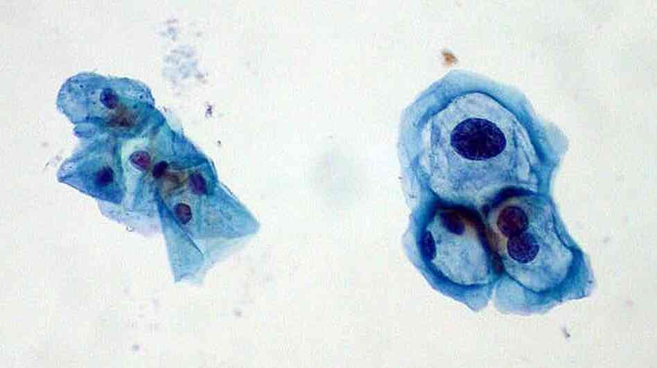 Cells gathered during a Pap test. Those on the left are normal, and those on the right are infected with human papillomavirus.