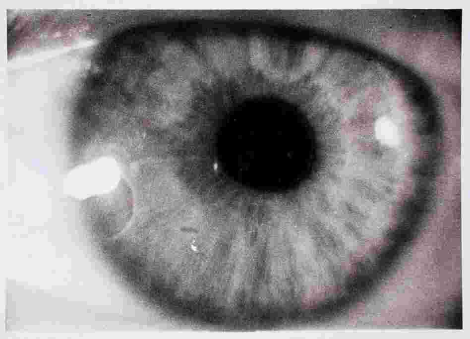 Diego's eye, 1936 