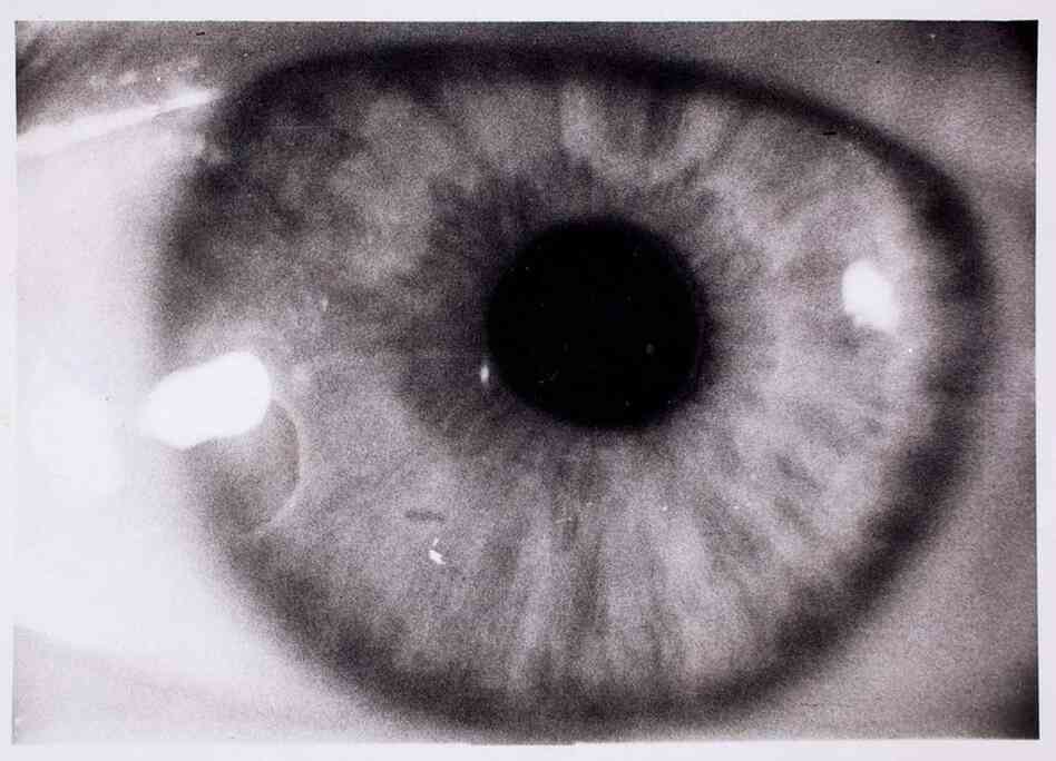 Diego's eye, 1936 