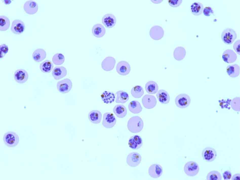 A micrograph shows red blood cells infected by the malaria parasite Plasmodium falciparum. A micrograph shows red blood cells infected by the malaria parasite Plasmodium falciparum.